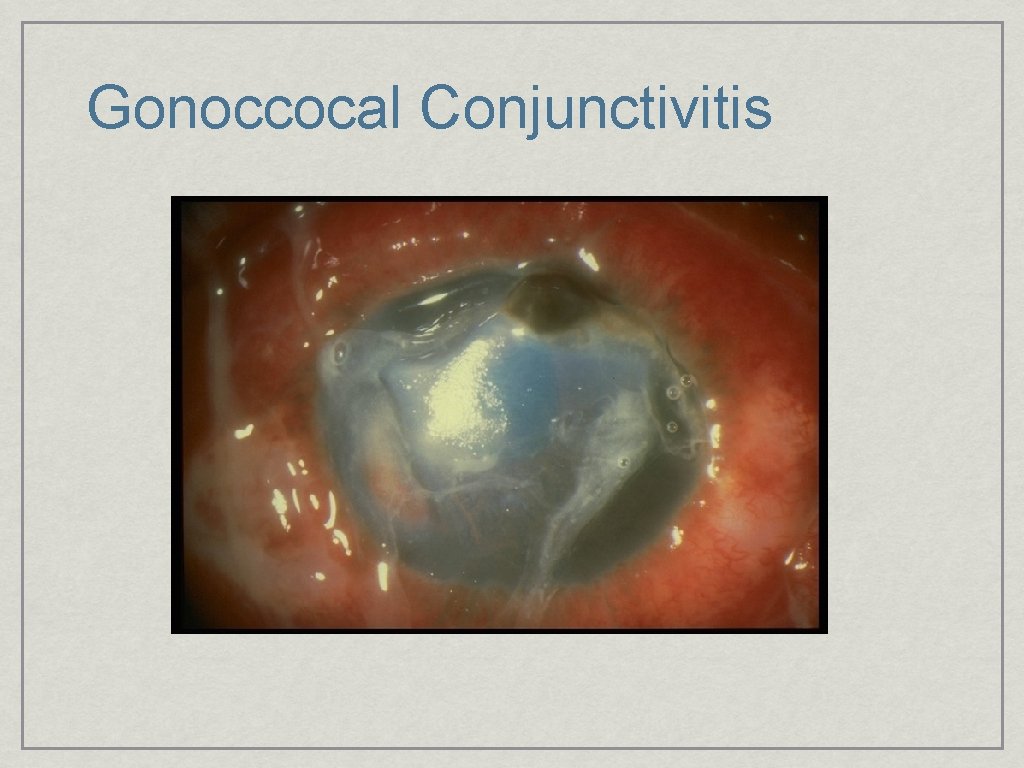 Gonoccocal Conjunctivitis 