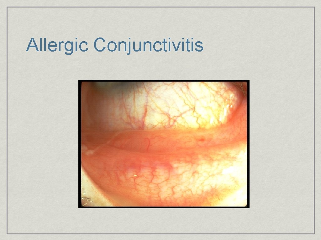 Allergic Conjunctivitis 