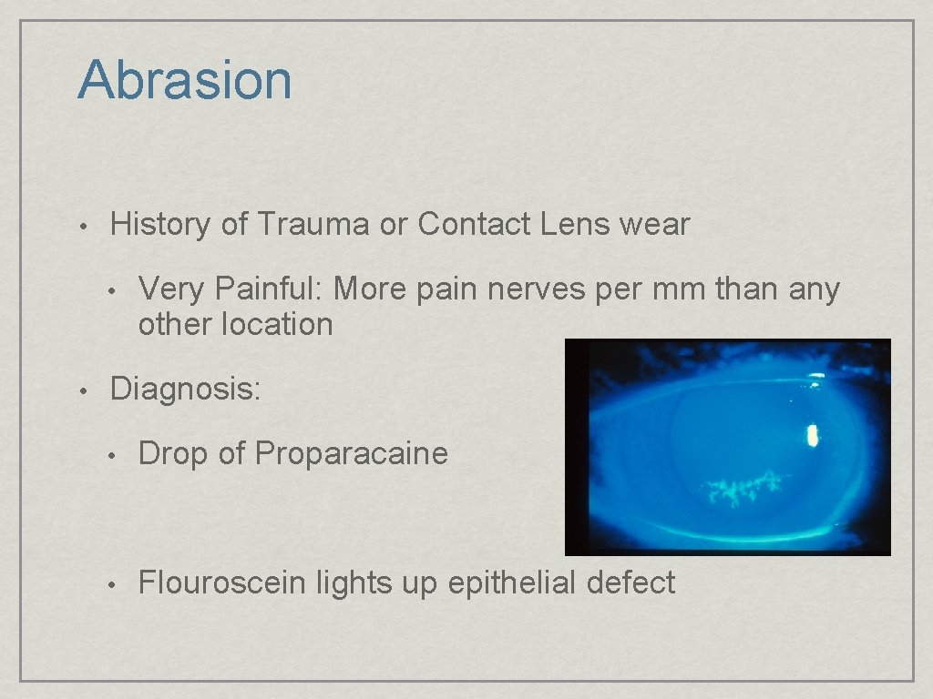 Abrasion • History of Trauma or Contact Lens wear • • Very Painful: More