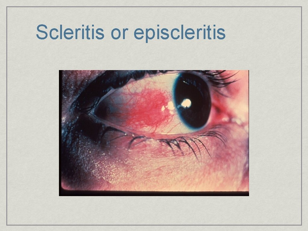 Scleritis or episcleritis 