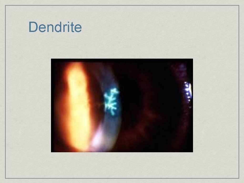Dendrite 