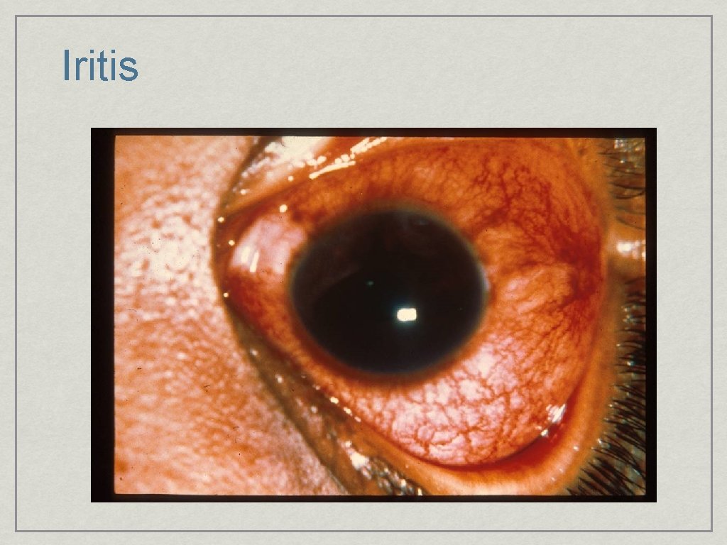 Iritis 