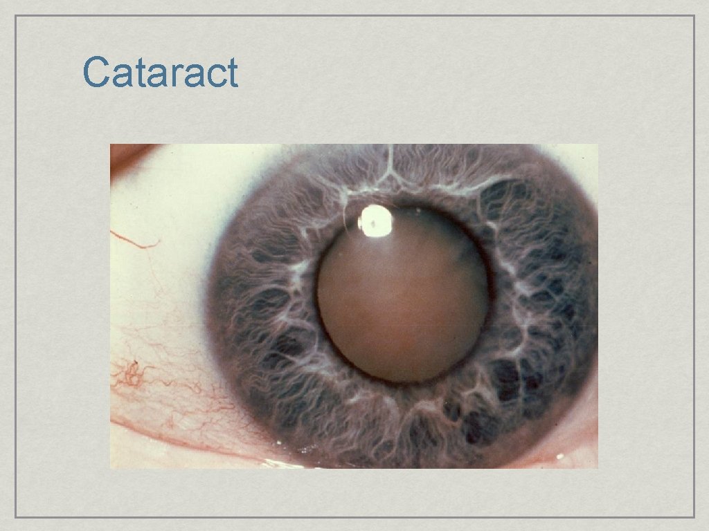 Cataract 
