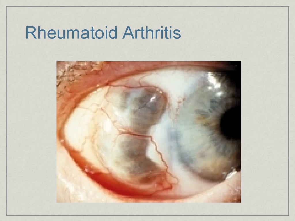 Rheumatoid Arthritis 