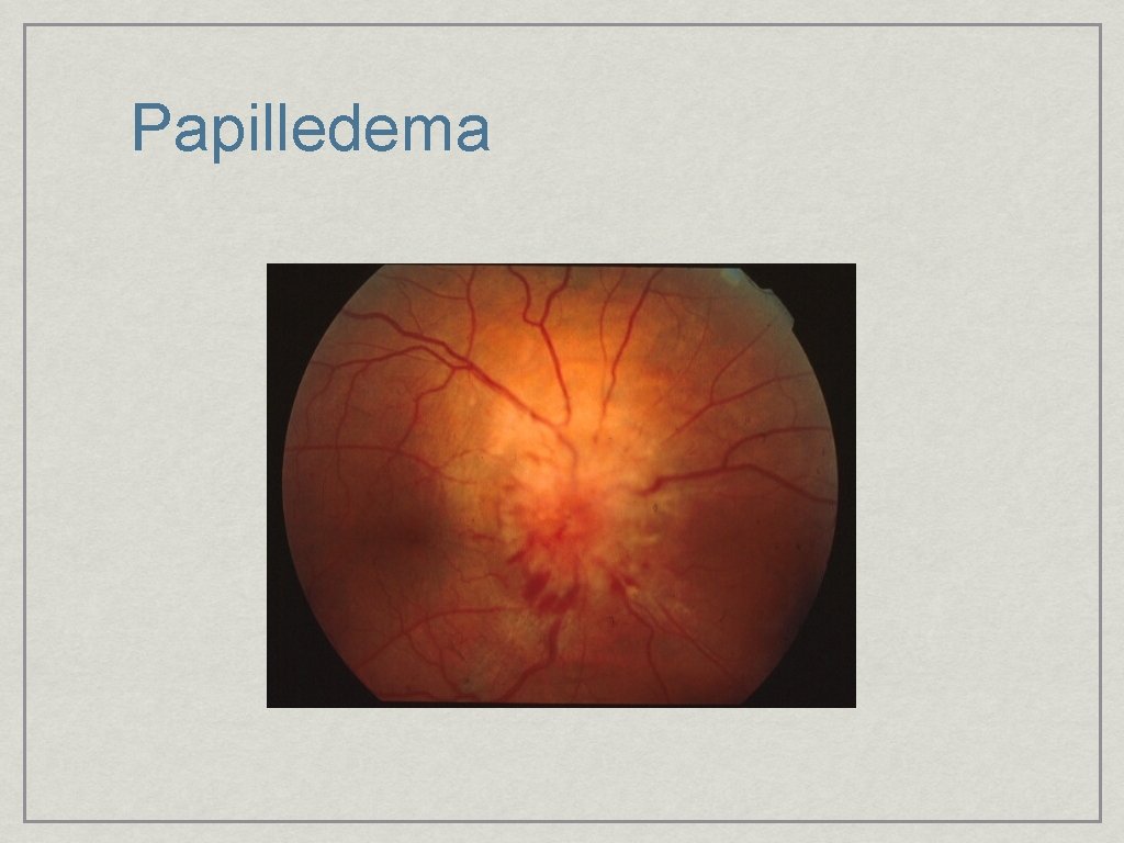 Papilledema 