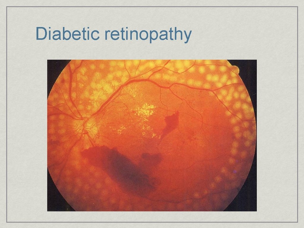 Diabetic retinopathy 