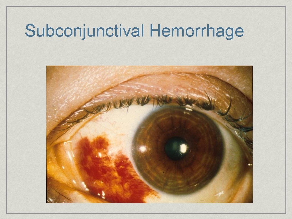 Subconjunctival Hemorrhage 