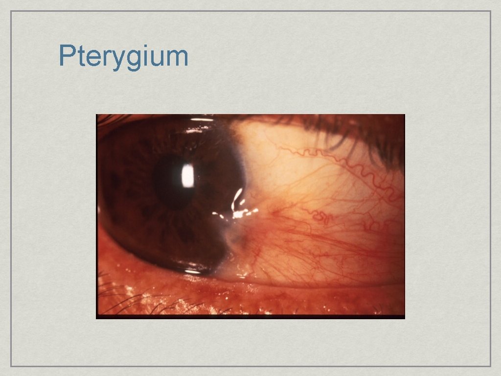 Pterygium 