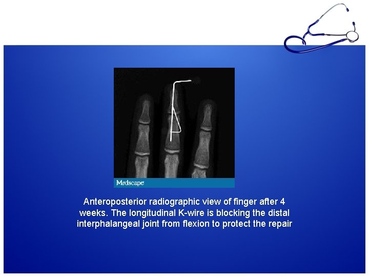 Anteroposterior radiographic view of finger after 4 weeks. The longitudinal K-wire is blocking the