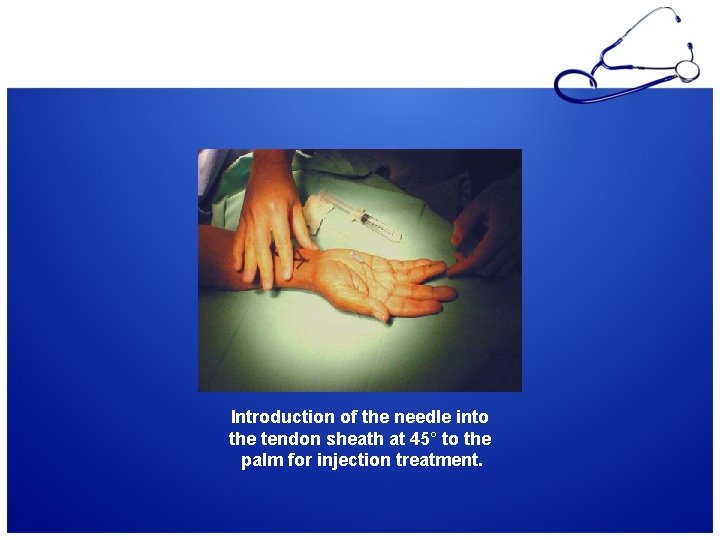 Introduction of the needle into the tendon sheath at 45° to the palm for
