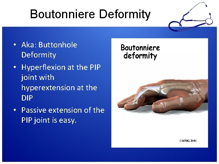 Boutonniere Deformity • Aka: Buttonhole Deformity • Hyperflexion at the PIP joint with hyperextension