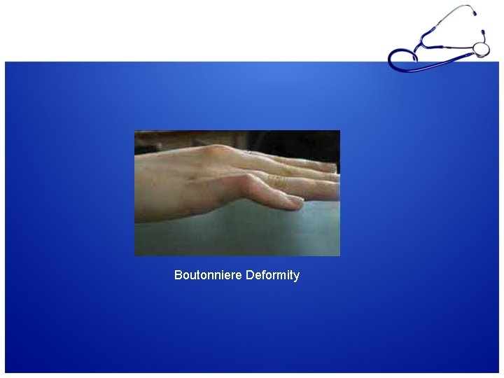 Boutonniere Deformity 
