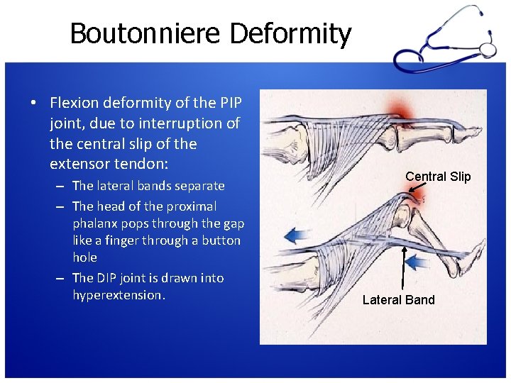 Boutonniere Deformity • Flexion deformity of the PIP joint, due to interruption of the