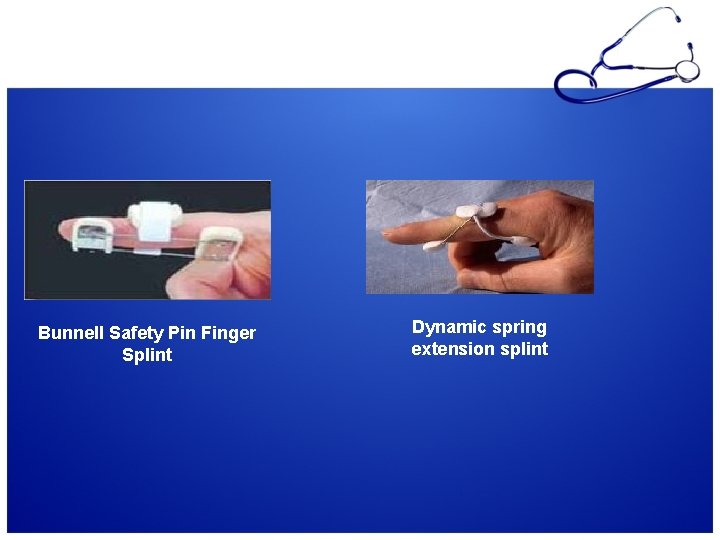 Bunnell Safety Pin Finger Splint Dynamic spring extension splint 