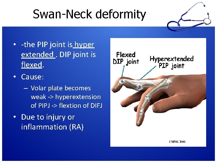 Swan-Neck deformity • -the PIP joint is hyper extended. DIP joint is flexed. •