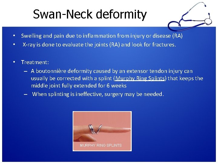 Swan-Neck deformity • Swelling and pain due to inflammation from injury or disease (RA)