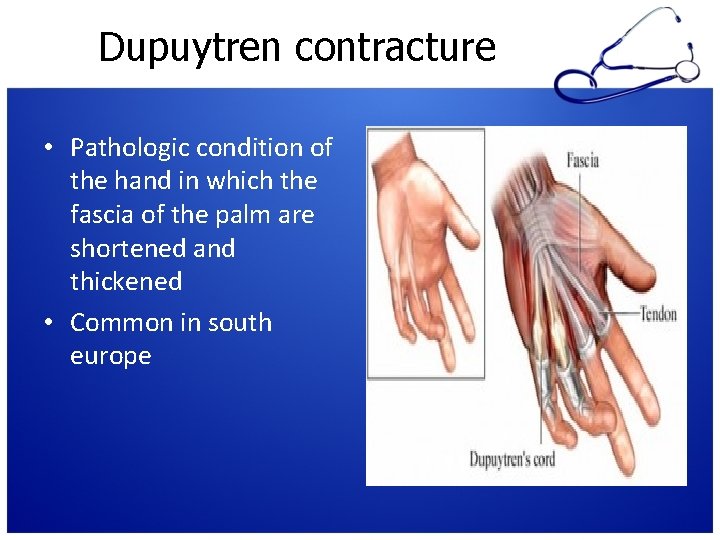 Dupuytren contracture • Pathologic condition of the hand in which the fascia of the