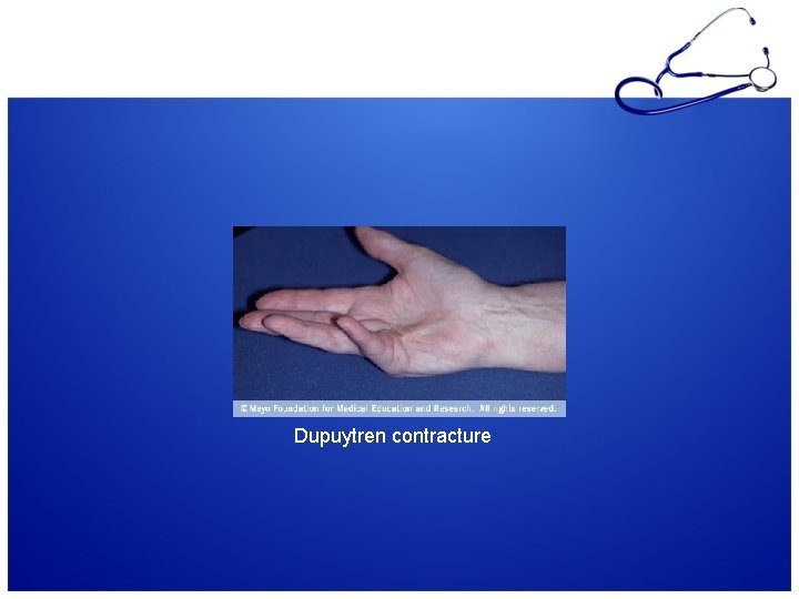 Dupuytren contracture 