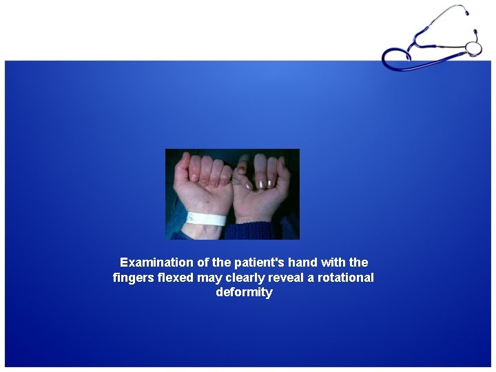 Examination of the patient's hand with the fingers flexed may clearly reveal a rotational