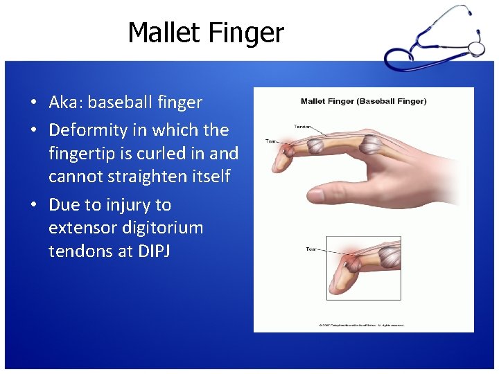 Mallet Finger • Aka: baseball finger • Deformity in which the fingertip is curled