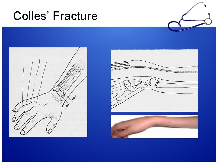 Colles’ Fracture 