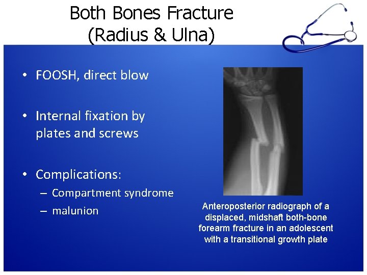 Both Bones Fracture (Radius & Ulna) • FOOSH, direct blow • Internal fixation by