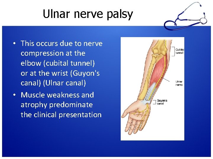 Ulnar nerve palsy • This occurs due to nerve compression at the elbow (cubital