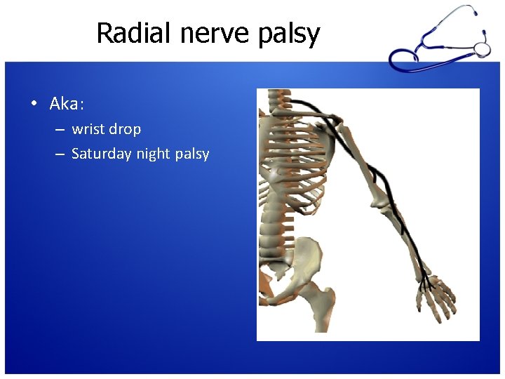 Radial nerve palsy • Aka: – wrist drop – Saturday night palsy 