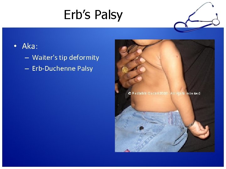Erb’s Palsy • Aka: – Waiter's tip deformity – Erb-Duchenne Palsy 