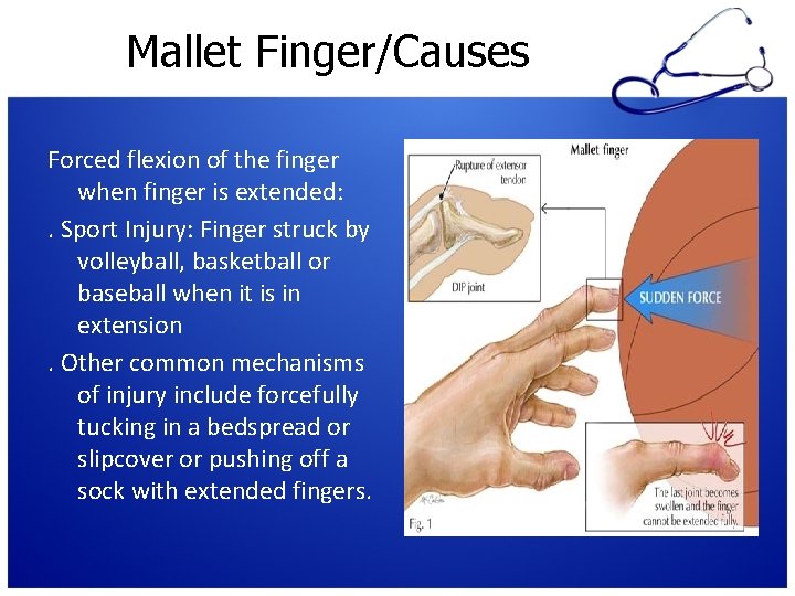 Mallet Finger/Causes Forced flexion of the finger when finger is extended: . Sport Injury: