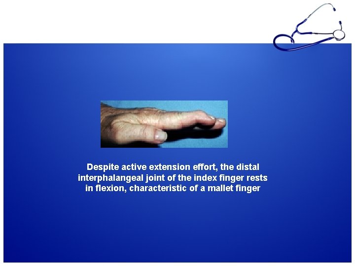 Despite active extension effort, the distal interphalangeal joint of the index finger rests in