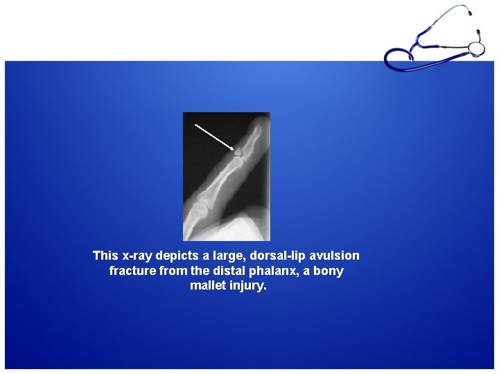 This x-ray depicts a large, dorsal-lip avulsion fracture from the distal phalanx, a bony