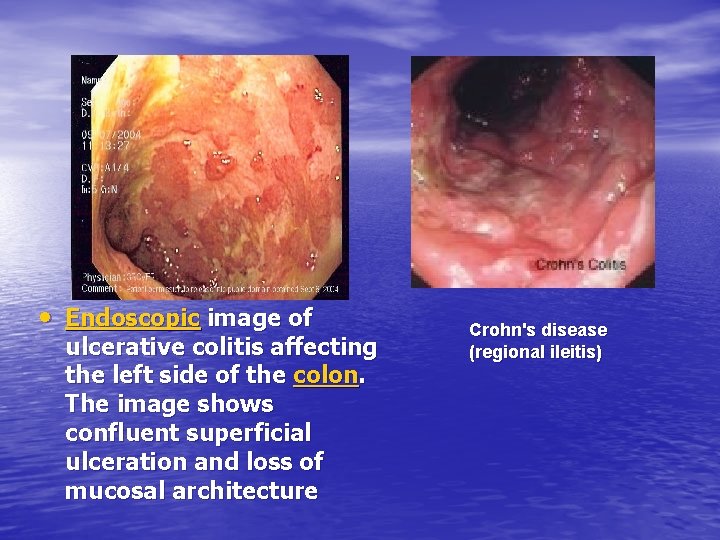  • Endoscopic image of ulcerative colitis affecting the left side of the colon.