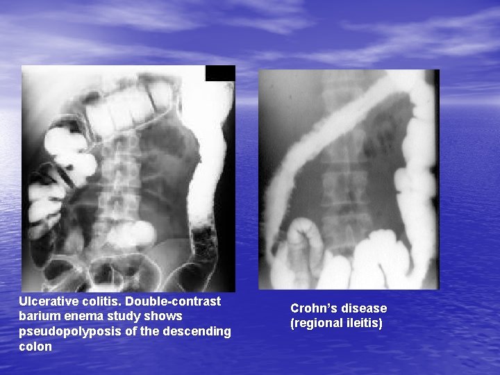 Ulcerative colitis. Double-contrast barium enema study shows pseudopolyposis of the descending colon Crohn’s disease