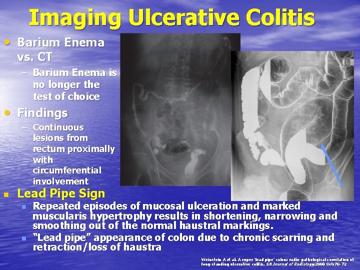 Imaging Ulcerative Colitis • Barium Enema vs. CT – Barium Enema is no longer