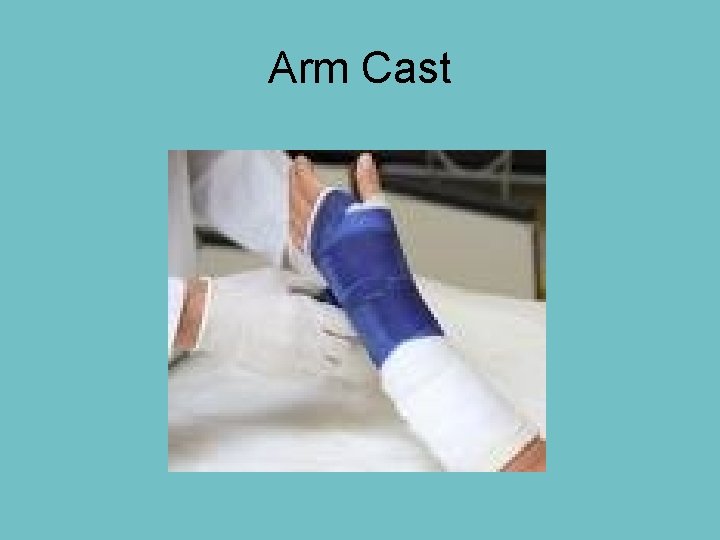 Arm Cast 