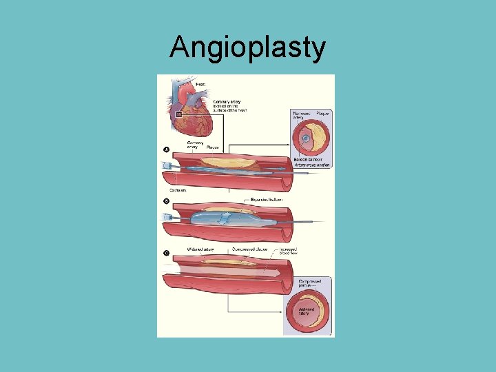 Angioplasty 