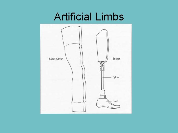 Artificial Limbs Artificial Limbs