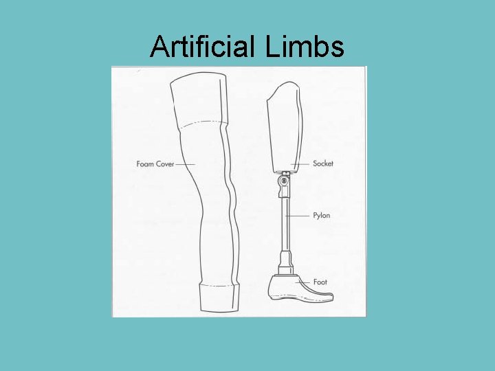 Artificial Limbs 