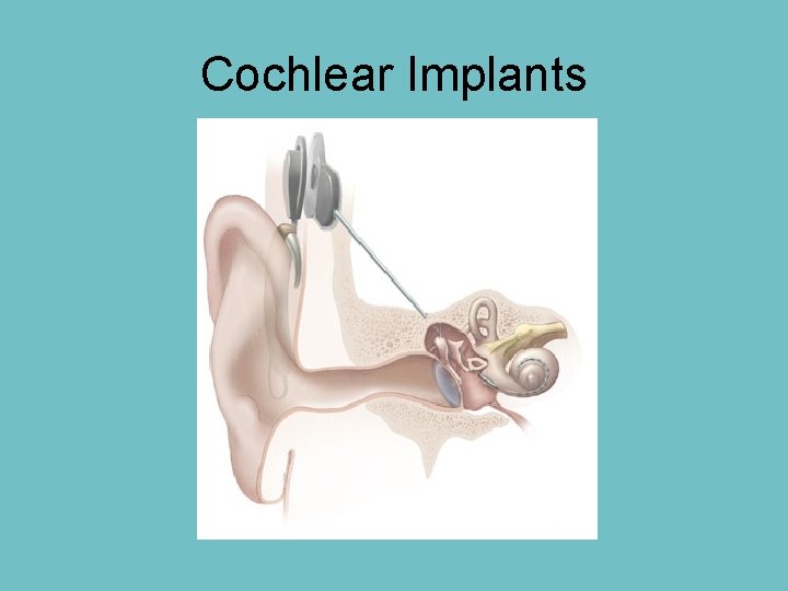 Cochlear Implants 