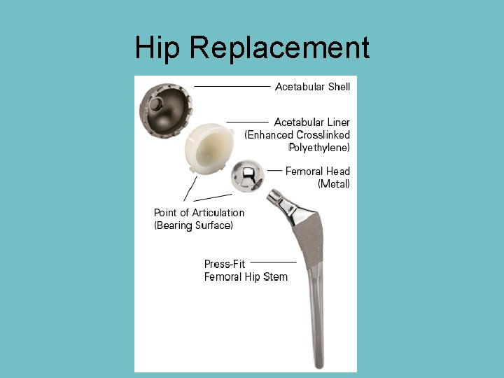 Hip Replacement Hip Replacement