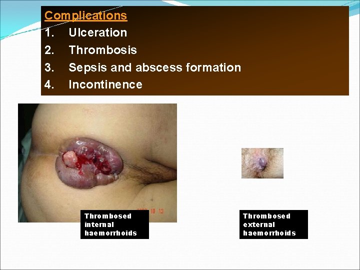 Complications 1. Ulceration 2. Thrombosis 3. Sepsis and abscess formation 4. Incontinence Thrombosed internal