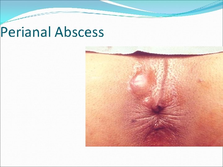 Perianal Abscess 