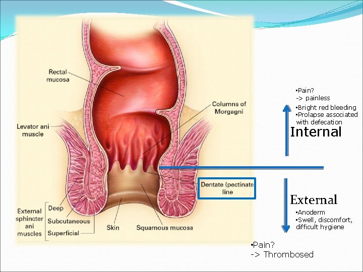  • Pain? -> painless • Bright red bleeding • Prolapse associated with defecation