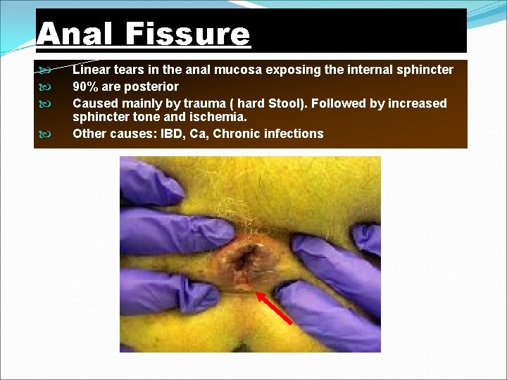 Anal Fissure Linear tears in the anal mucosa exposing the internal sphincter 90% are
