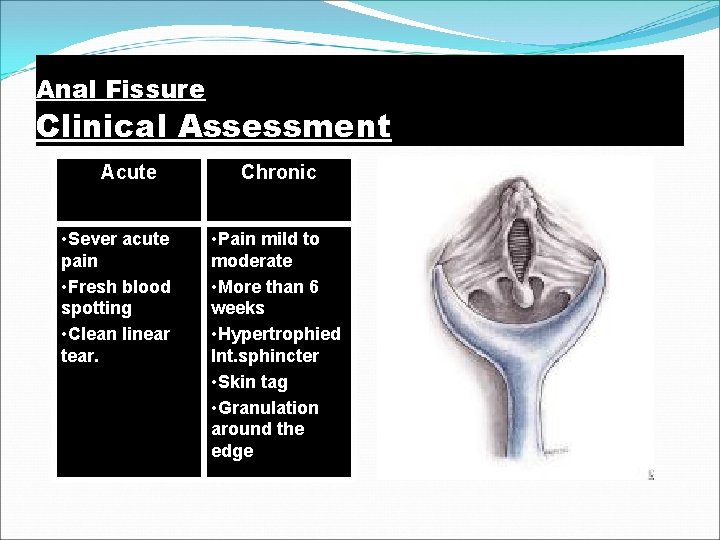 Anal Fissure Clinical Assessment Acute • Sever acute pain • Fresh blood spotting •