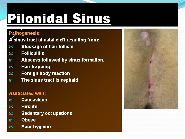 Pilonidal Sinus Pathogenesis: A sinus tract at natal cleft resulting from: Blockage of hair