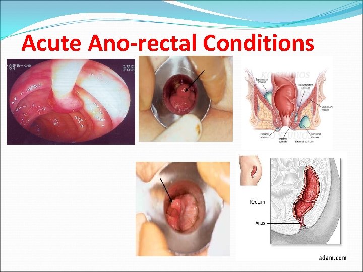 Acute Ano-rectal Conditions 
