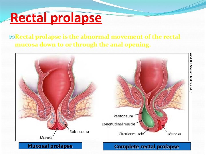 Rectal prolapse is the abnormal movement of the rectal mucosa down to or through
