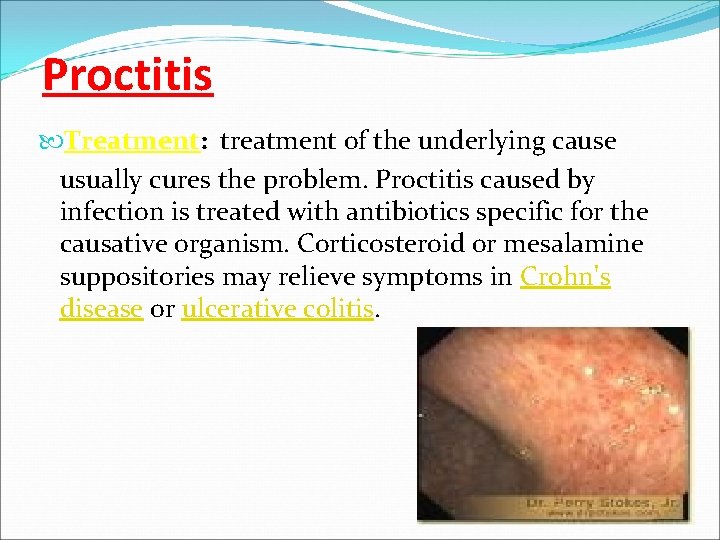 Proctitis Treatment: treatment of the underlying cause usually cures the problem. Proctitis caused by